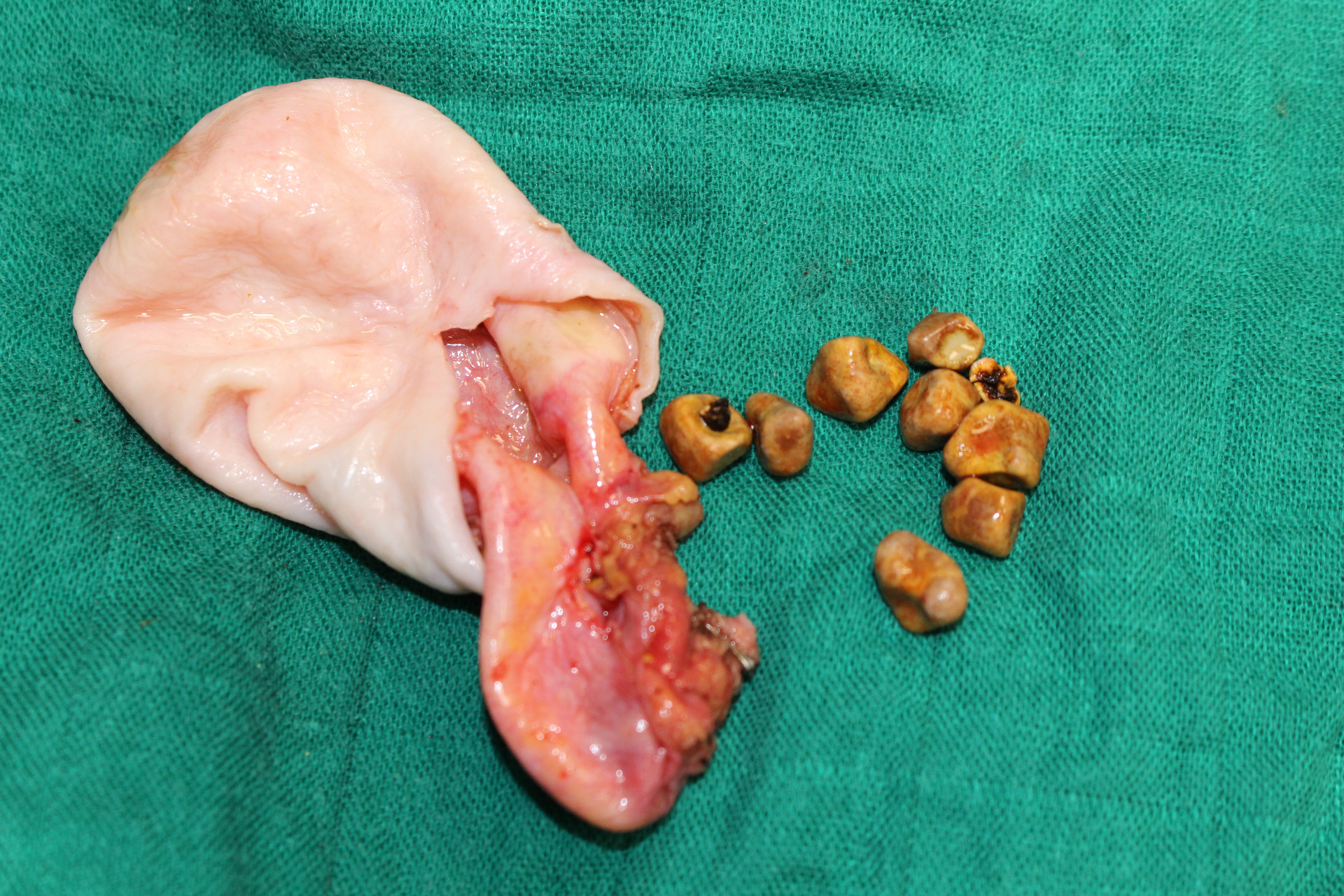 #1 - opération d'une Vésicule biliaire