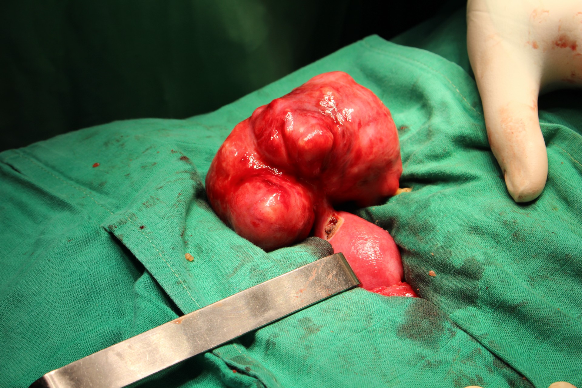 Opération #1 - Fibrome