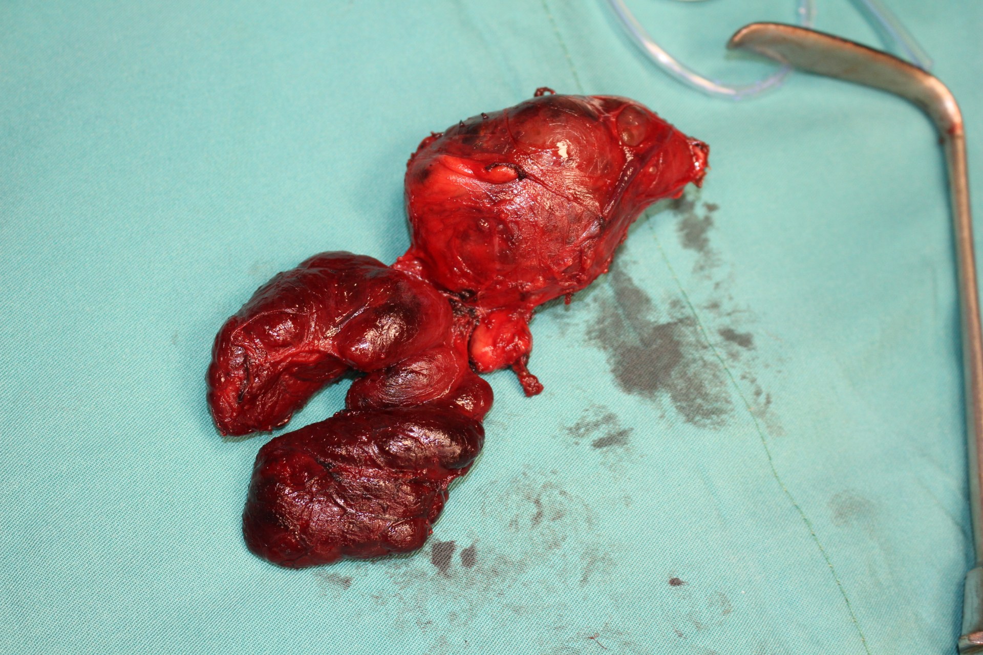 Opération de la tyroide - Partie #1