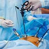 Chirurgie cœlioscopique par caméra